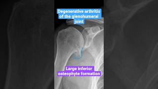 Degenerative arthritis (DJD) of the shoulder #shoulder #arthritis #radiology